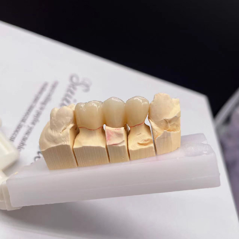 Crowns And Bridges - TopWay Dental Lab
